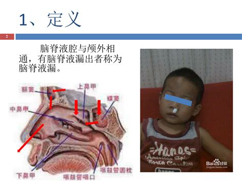 脑脊液漏的诊治 Word文档在线阅读与下载 无忧文档