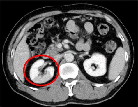 Medicina Free Full Text Asymptomatic Idiopathic Renal Infarction