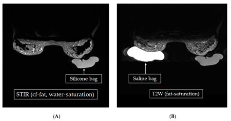 Developing a Specific MRI Technology to Identify Complications Caused