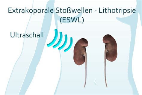 Nieren Und Harnleitersteine Urologie Uro Onkologie Spezielle