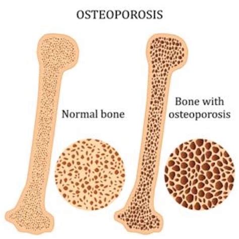 Early Signs And Symptoms Of Osteoporosis Health Site