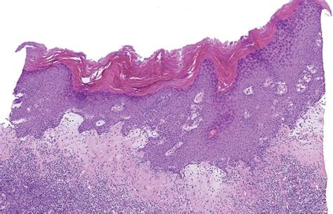 Balanitis Xerotica Obliterans Histology