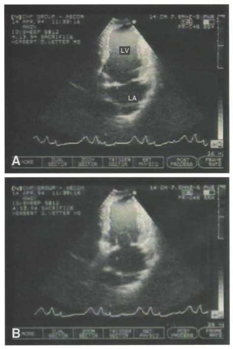 Two Dimensional Echocardiogram Left Ventricular Long Axis During