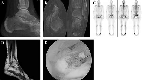 Figure 1 From Osteoid Osteoma Of The Talus Presenting As Posterior