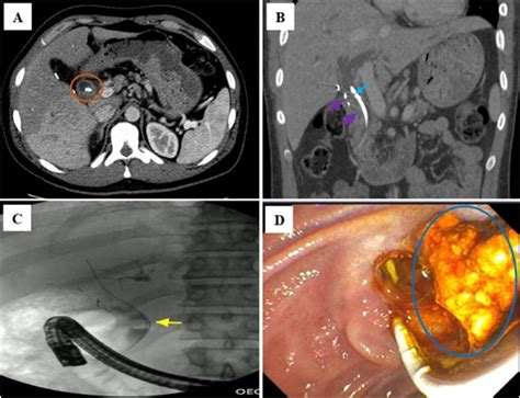 Ct Imaging Features Of Bile Duct Stent Complications Clinical Imaging