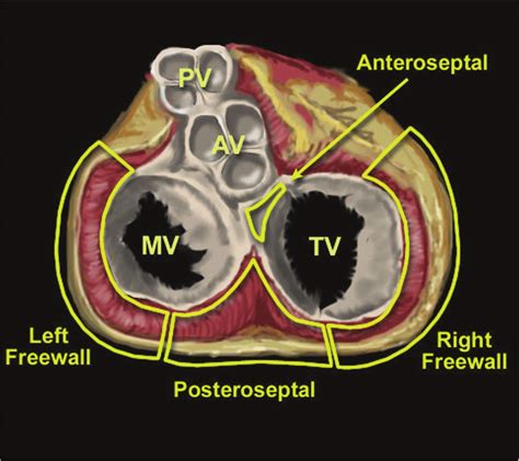 Anatomic Locations Of Atrioventricular Accessory Pathway In A Superior Download Scientific