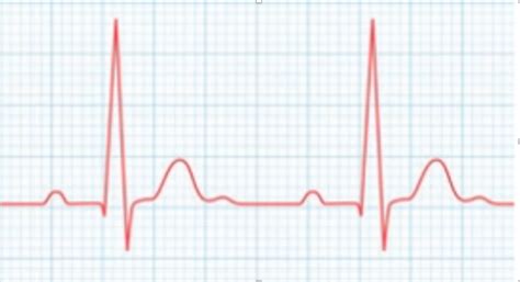 ECG Waves and Segments Diagram | Quizlet