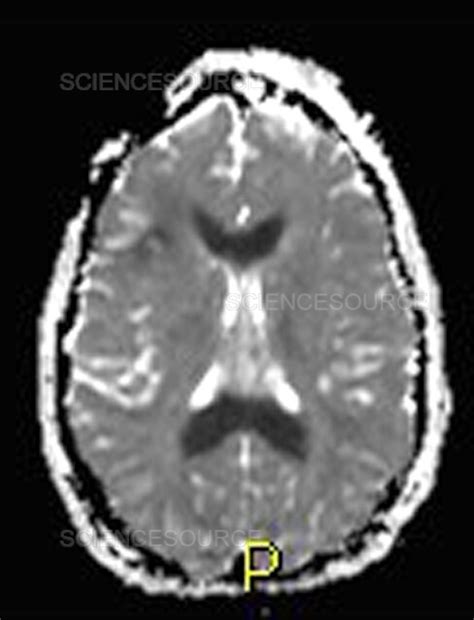 Photograph | Severe Traumatic Brain Injury, MRI | Science Source Images