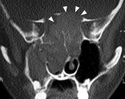 Imaging Features Of Invasive And Noninvasive Fungal Sinusitis A Review