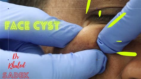 Face Cyst Removal Dr Khaled Sadek LipomaCyst YouTube