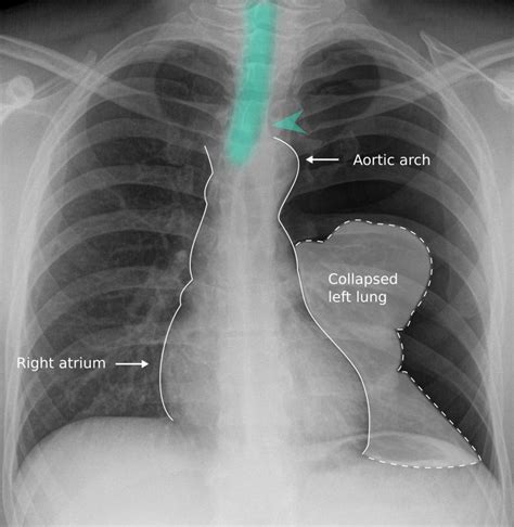 Tension Pneumothorax Tracheal Deviation