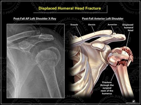 Displaced Humeral Head Fracture