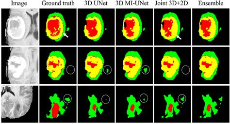 Frontiers Brain Tumor Segmentation From Multi Modal Mr Images Via