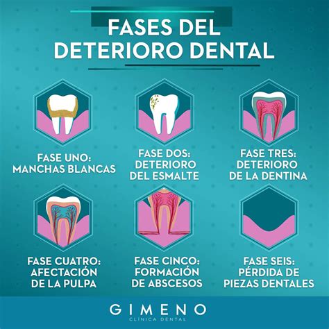 Las 6 fases de cómo se producen las caries Clínica Gimeno