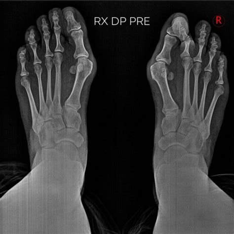 Cirug A De Juanetes Hallux Valgus Y Dedo En Garra