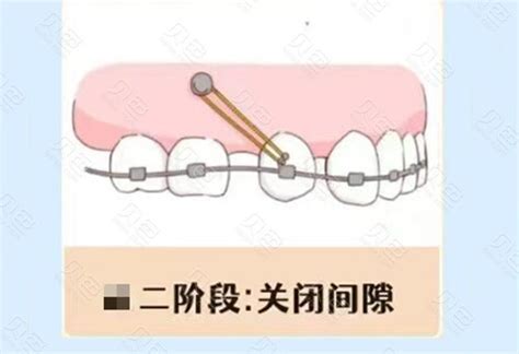 隐形牙套好还是钢丝牙套好？从多方面深入分析一下~ 贝色口腔