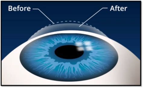 Correct Refractive Surgery In Thin Corneas Eyemantra Hospital