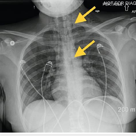 Chest X-ray showing pneumomediastinum and subcutaneous emphysema at the ...