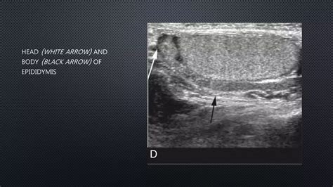 ULTRASOUND SCROTUM PPT