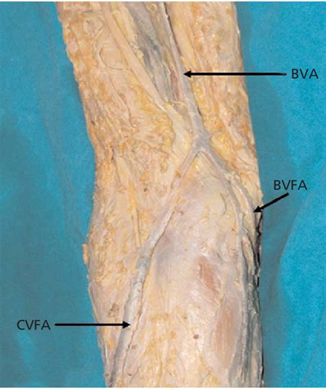 Cephalic Vein