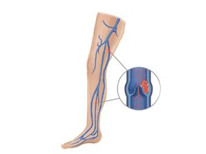 Como Evitar A Trombose Ap S Cirurgias