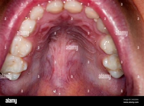 Hyper Ige Syndrome Mouth Of A Year Old Male Patient With