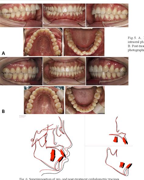 Figure 6 From Morphology Changes Of Maxillary Molar Distalization By