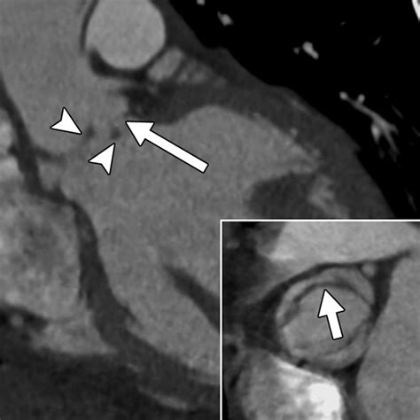 Bicuspid Aortic Valve Spectrum Of Imaging Findings At Cardiac Mdct And