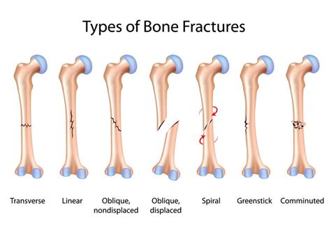 Trauma And Fractures Oasis Orthopaedics Melbourne