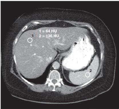 Liver CT Scan With Contrast