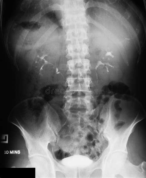 X Ray Image Plan Kub Supine View Stock Photos Free And Royalty Free