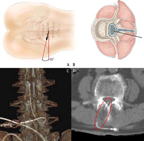 Figure From Lumboperitoneal Shunt Surgery Under Rachianesthesia