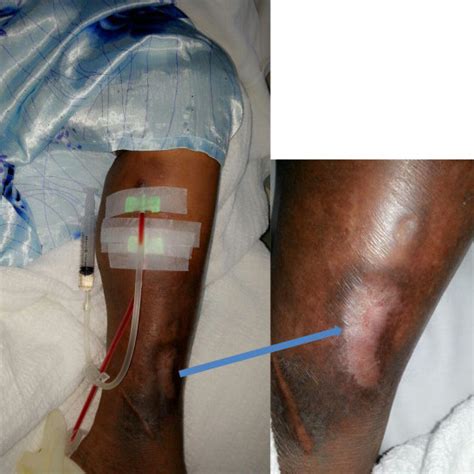 Left ankle arteriovenous fistula (AVF) during hemodialysis with healed ...