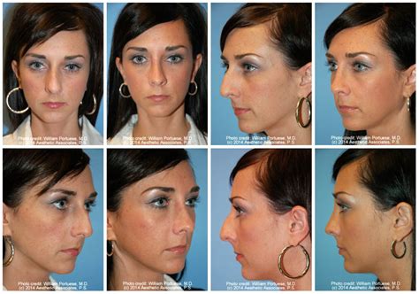 Rhinoplasty And Chin Implant Before And After Rhinoplasty Patients