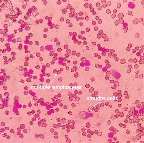 Lymphocytic Leukocytosis R Pathology