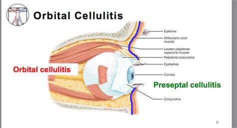 Wk 2 Day 4 Orbital Cellulitis Flashcards Quizlet