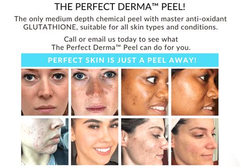 Facial Peel Derma Peel Chemical Peel South Gate CA