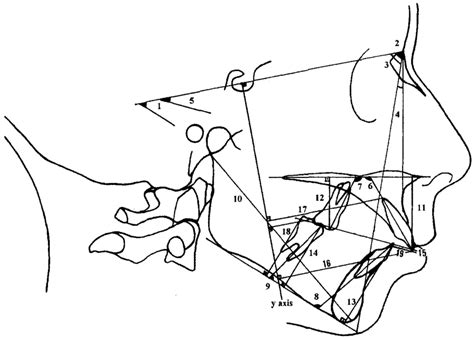 Angular Cephalometric Measurements 1 Sn Gogn Angle 2 Sna Angle Download Scientific