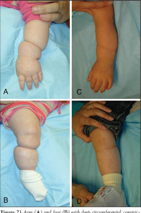 Amniotic Band Syndrome Arm