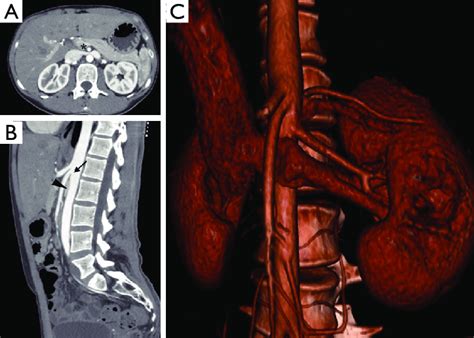 Axial And Sagittal Computed Tomography Angiography Cta Computed