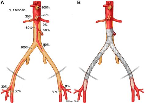 Covered Endovascular Reconstruction Of The Aortic Bifurcation With