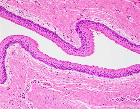 Nevoid Basal Cell Carcinoma Syndrome Histology