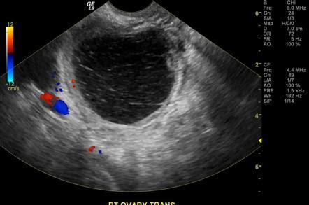 Hemorrhagic ovarian cyst | Radiology Reference Article | Radiopaedia.org