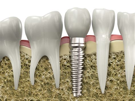 Single Tooth Implants American River Dental Rancho Cordova Dentist