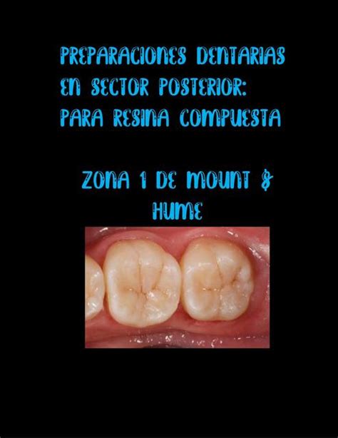 Preparaciones Dentarias Zona Mount Hume Ameli Udocz