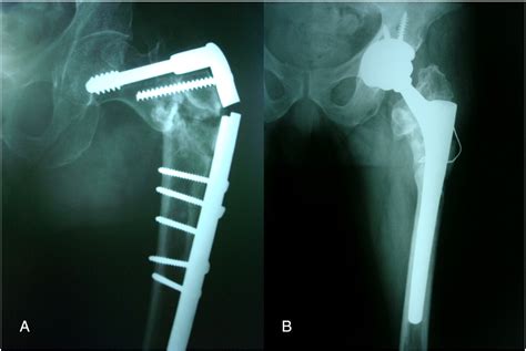 Salvage Of Failed Trochanteric Fracture Fixation Using The Revitan