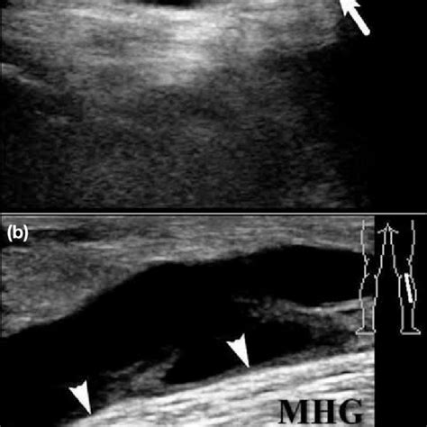 Baker S Cyst With Caudal Extension A Longitudinal Sonogram Shows A