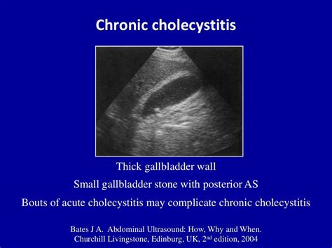 Ultrasound of acute & chronic cholecystitis