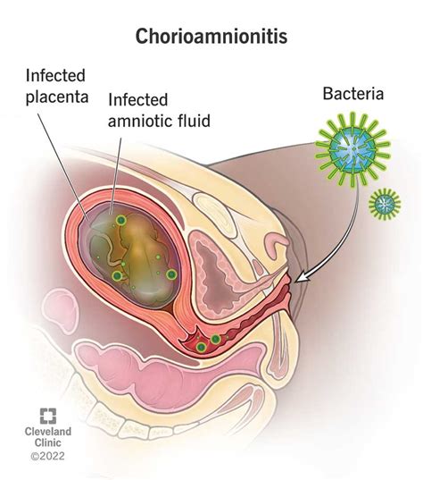 Corioamnionite Cause Sintomi Diagnosi E Trattamento SFOMC