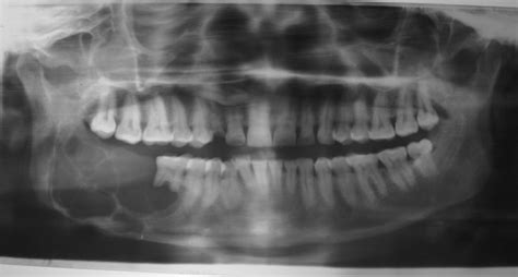 Orthopantamograph Showing A Well Defined Multilocular Lesion On Right